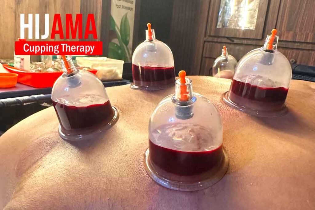 hijama